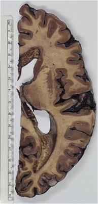 Fixation and staining methods for macroscopical investigation of the brain